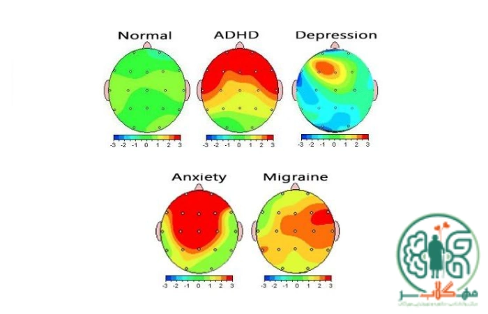 نمونه‌هایی از نقشه مغزی در افراد مختلف
