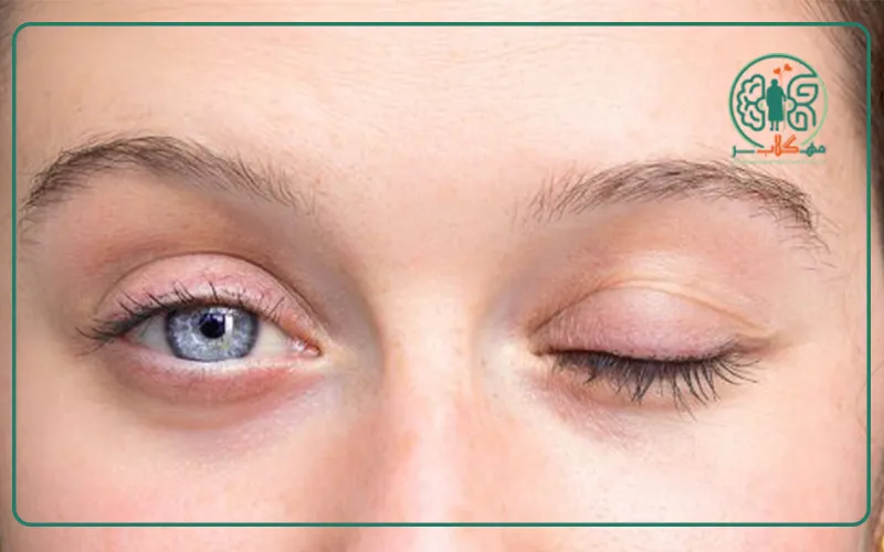 راه های درمان فلج بل یا فلج صورت